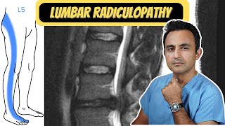 Lumbar Radiculopathy quotSciaticaquot [upl. by Chu]