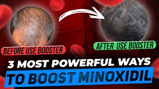 Minoxidil Boosters  3 Most Powerful Ways to Make Minoxidil MORE Powerful [upl. by Dhiman]