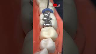 ¡🔥Instalación de separadores dentales y bandas metálicas en las muelas 0🦷0🔥 [upl. by Gilbart]