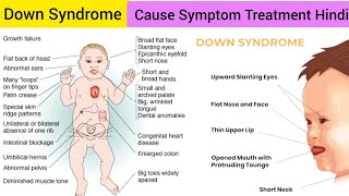 Down Syndrome Cause Symptoms Diagnosis Treatment in Hindi  Trisomy 21 Cause Symptom Treatment Hindi [upl. by Hoffman]