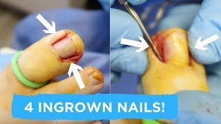 QUADRUPLE INGROWN NAIL SURGERY [upl. by Anirehs]