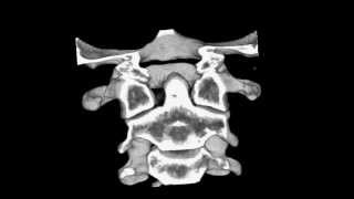 Cervical spine CT scan Atlantoaxial subluxation [upl. by Isla]