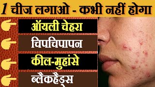 ऑयली स्किन के लिए घरेलू उपाय  Best Face Pack To Cure Oily Skin  oily skin ke liye face pack [upl. by Syck]