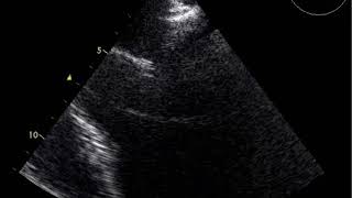 Transesophageal echocardiography TOEendocarditis of mitral valve with a small vegetation [upl. by Doowle491]