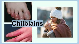 chilblains [upl. by Eerak]