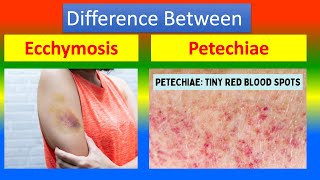 Distinction Between Ecchymosis and Petechiae [upl. by Aisyram]