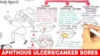 Aphthous Ulcers  Canker Sores  Pathophysiology Triggers Types amp Treatment [upl. by Nonarb594]