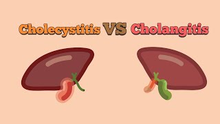 Difference between Cholangitis and Cholecytitis [upl. by Akimak]