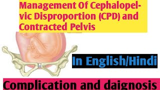 Management Of Cephalopelvic Disproportion CPD amp Contracted Pelvis II Nightingale Nursing Nursing [upl. by Attenyw]