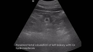 CASE 998 Persistent fetal lobulation of left kidney with GI hydronephrosis [upl. by Armmat]