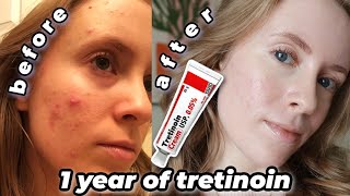 1 YEAR TRETINOIN UPDATE Before amp After  My Current Skincare Routine tretinoin cream 005 [upl. by Holder886]