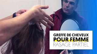 Greffe de cheveux femme sans rasage😮  Turkisme Medical [upl. by Bonnell]