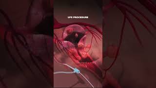 What is Uterine Fibroid Embolization procedure Types of Fibroids fibroid pregnancy animation [upl. by Galer]