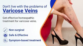 Vericose Veins Treatment  Scelero Therapy vericose veins yt treanding viralvideo [upl. by Mychal]