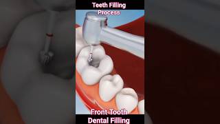 Tooth Filling Procedure Animation Teeth Filling Process [upl. by Ostler580]