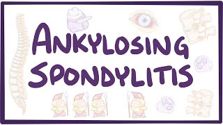 Ankylosing spondylitis  causes symptoms diagnosis treatment pathology [upl. by Bergquist]