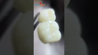 Zirconia crown trending viralshorts hamidraza01 ideal2 dental lab Pune [upl. by Enavi]