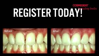 Diastema Closure Webinar preview [upl. by Westfahl]