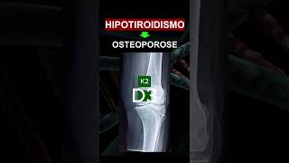 HIPOTIROIDISMO  OSTEOPOROSE [upl. by Adyeren]