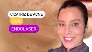 Endolaser para cicatriz de acne [upl. by Charla]