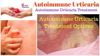 Autoimmune Urticaria  Autoimmune Urticaria Treatment Options  Autoimmune Urticaria Treatment [upl. by Werra]