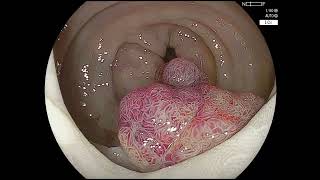 ESD of Recurrent Tubulovillous adenoma  highgrade dysplasia with fibrosis and tattoo in submucosa [upl. by Ahsyla]