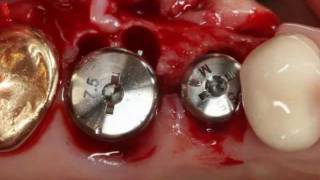 Immediate implantation  Implant advanced [upl. by Nitnert]