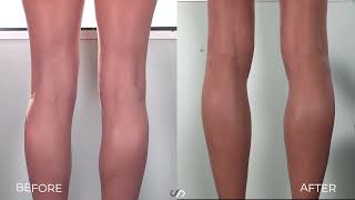 How to Get Rid of Cankles Using Liposuction  Los Angeles [upl. by Esinnej]