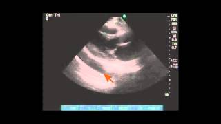 Pleural Effusion Causes ClassificationSymptoms and Treatment [upl. by Irby]