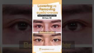 Lowering vs Removing double eyelid creases Check the difference out [upl. by Thornton]