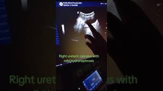 Right Ureteric Calculus with mild Hydronephrosis [upl. by Jer]