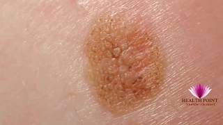 Melanoma Pictures  Signs Symptoms Causes Photos Images Pictures of Melanoma Skin Cancer [upl. by Tillio]