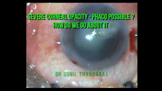 Phacoemulsification in a case of severe Corneal Opacification [upl. by Lal]