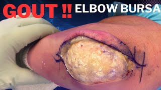 Elbow Olecranon Bursitis Gout Treated in 3 minutes [upl. by Anwahsal]