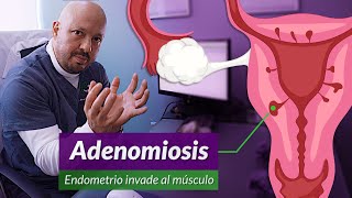 Cirugía por Adenomiosis Y diferencia con miomas y endometriosis [upl. by Cerveny]