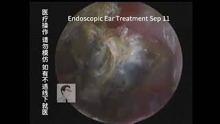 Ear wax removal Oily cerumen and fungal cleaning 🧹 20230911 [upl. by Airelav]