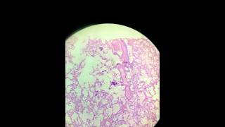 bronchial pneumonia [upl. by Loesceke348]