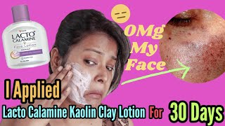 LIVE RESULT I Applied LACTO CALAMINE KAOLIN CLAY FACE LOTION For 30 Days  Shinny Roops [upl. by Aleacem292]