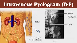 Intravenous pyelogram IVP [upl. by Millford]