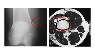 Bone Tumors 3  Chondrogenic Tumors [upl. by Adnahsor]