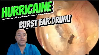 HURRICAINE BURST EAR DRUM 351 ear earwax earwaxremoval satisfying foryou fyp foryourpage [upl. by Ahsekar841]