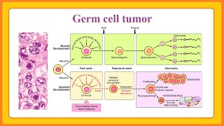 germ cell tumor [upl. by Nebe]