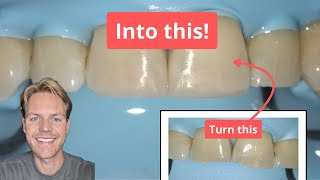 How I Fixed Chipped Front Teeth Full Restoration Process Explained [upl. by Leba339]