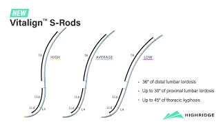 Highridge Medical Vitalign™ SRods [upl. by Loomis547]