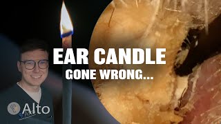 This Ear Candle Makes Hearing WORSE  Ear Wax Removal [upl. by Esmerelda]