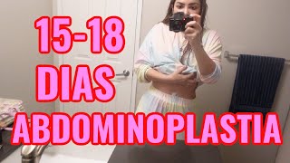 ABDOMINOPLASTIA 15  18 DIAS DESPUES [upl. by Cynthie436]