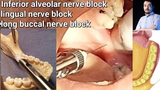 Local Anesthesia Inferior Alveolar Nerve block amp long buccal Nerves block Mandibular nerve block [upl. by Nitsur753]