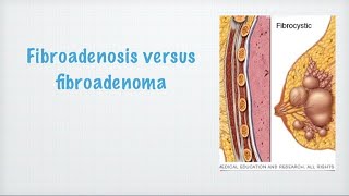 Fibroadenosis vs fibroadenoma medicohelpcom [upl. by Ulberto595]