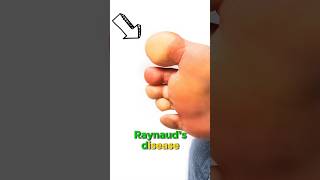 Do you have Raynauds The Dos and Donts [upl. by Amaryl]