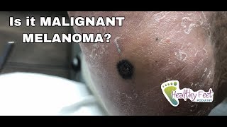 Is it Malignant Melanoma [upl. by Nnagem869]